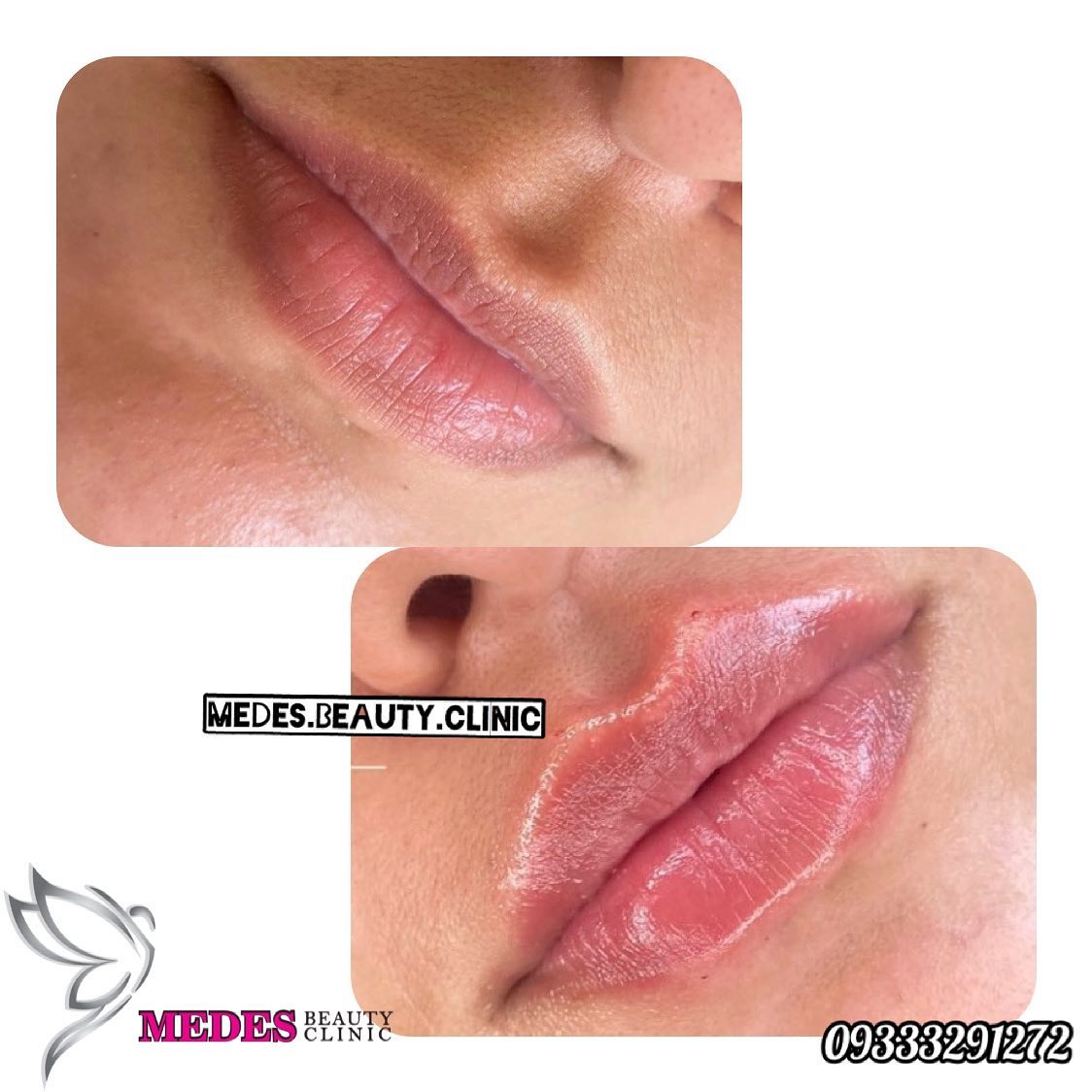 گالری تزریق ژل لب